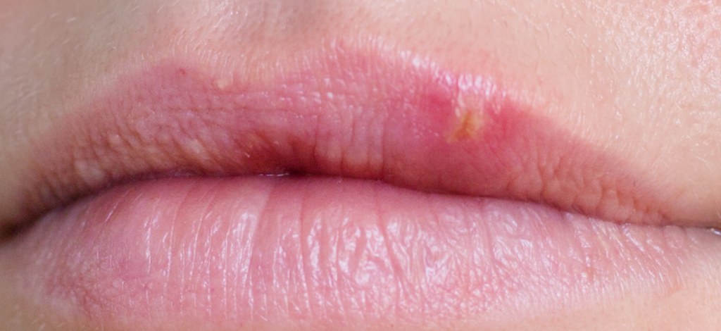 Pictures | Cold Sores