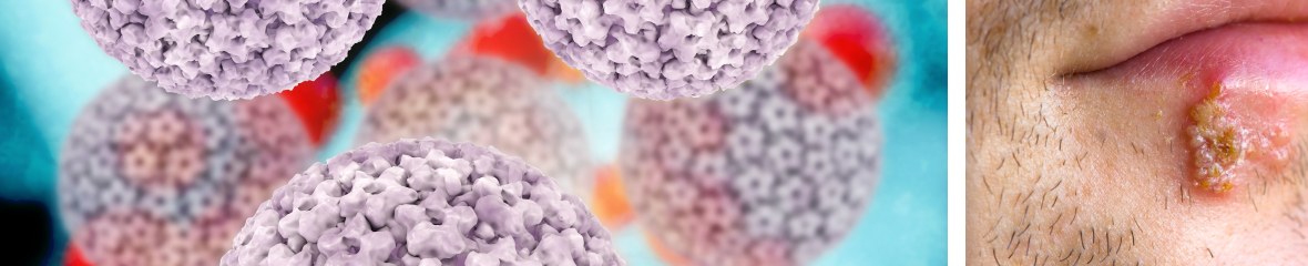 HSV-1 Infections | Cold Sores